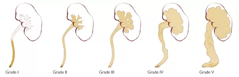 bobrekreflusudereceleri-4 Böbrek Reflü Dereceleri