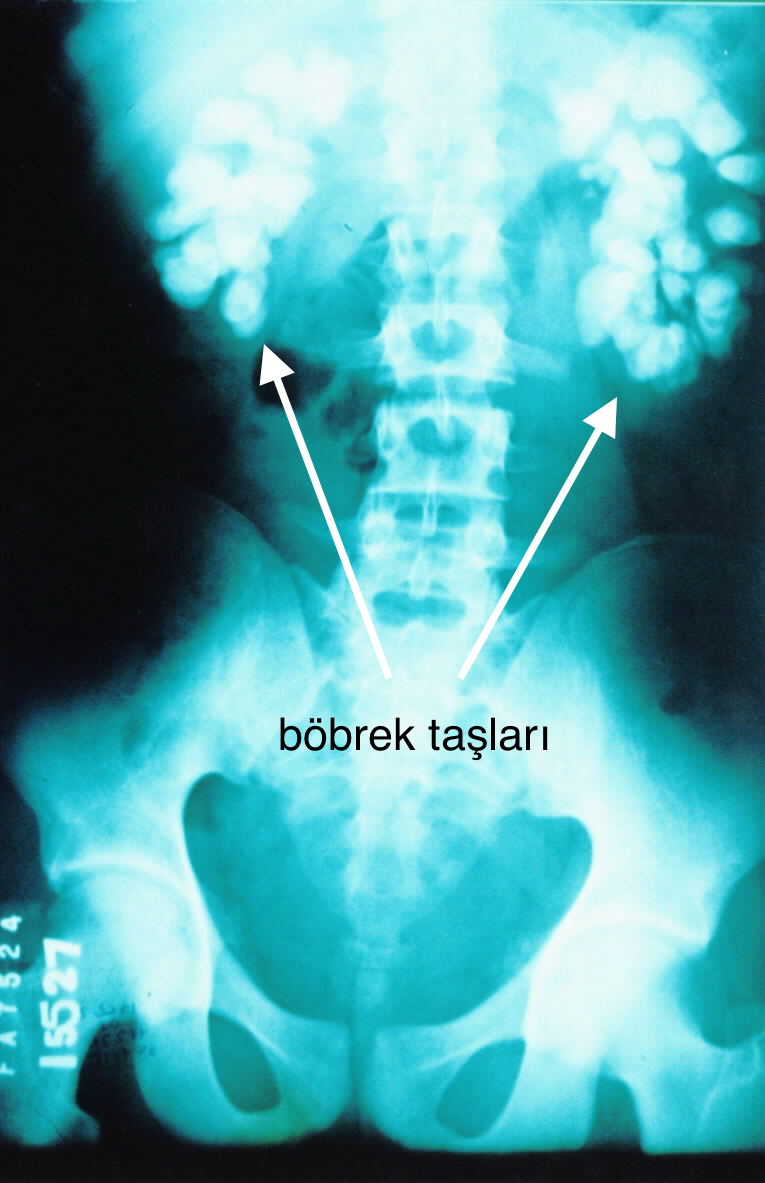 Önol Üroloji Önol Üroloji