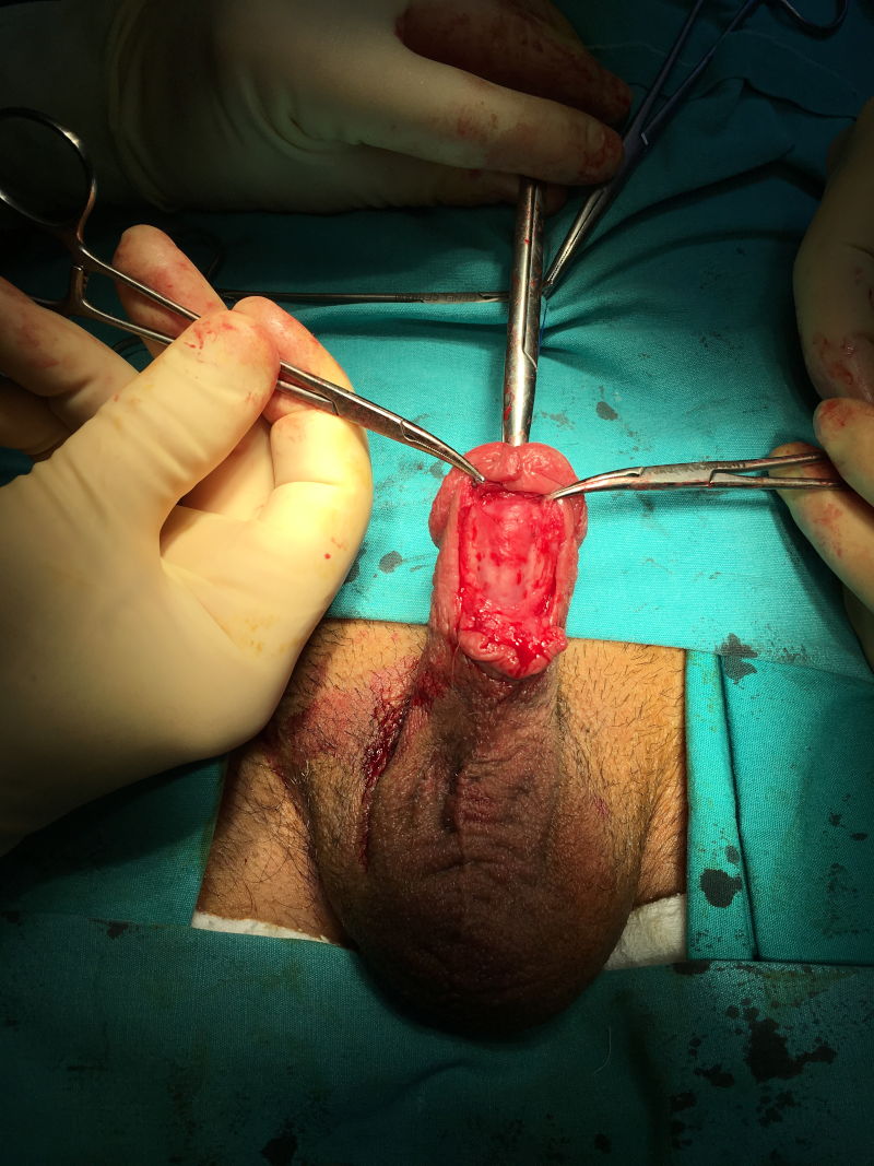 Urethral (Urinary Channel) Stricture in Men 9 idrarkanalidarligi2