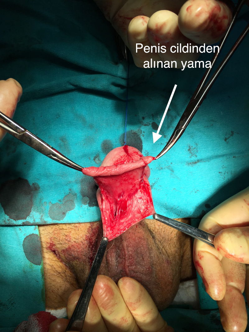 Urethral (Urinary Channel) Stricture in Men 8 idrarkanalidarligi3