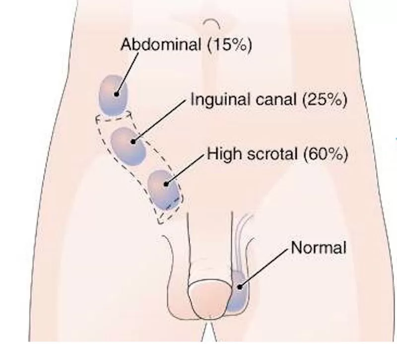 inmemistestisnedir-4 İnmemiş Testis