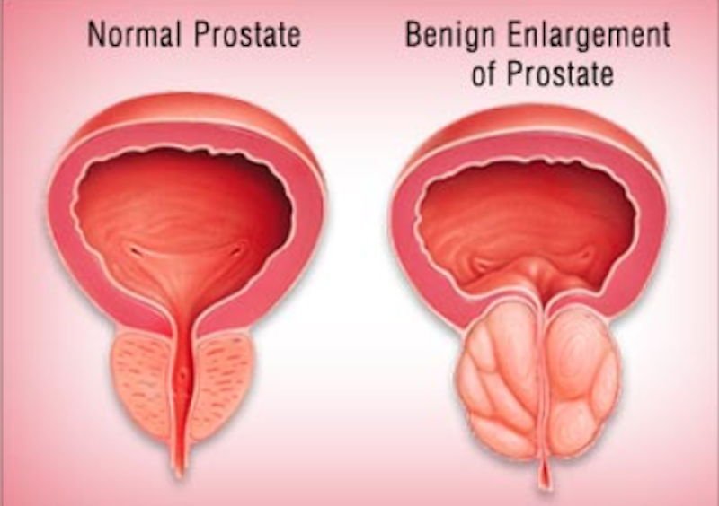Prostat Büyümesi Nedir