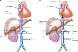 سرطان الكلى 5 Radikal Nefrektomi Ameliyatı