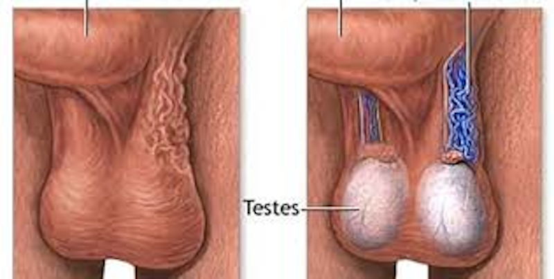 varikosel-5 Varikosel